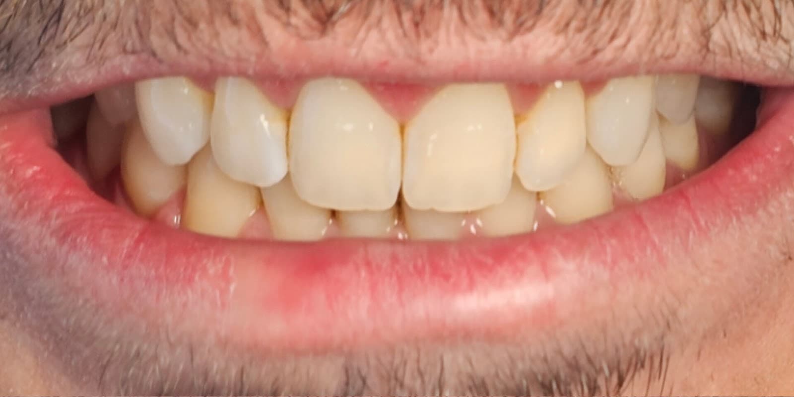 Arcada dental antes do protocolo de clareamento
