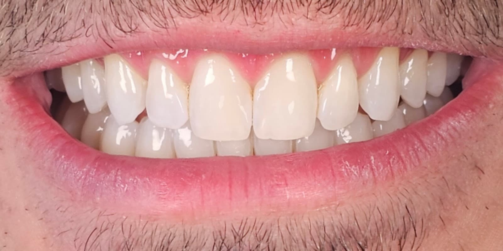Resultado após clareamento dental com máxima naturalidade